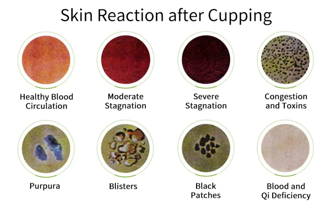 12-Piece Vacuum Cupping Therapy Set With Pump - Omega Lifestyles