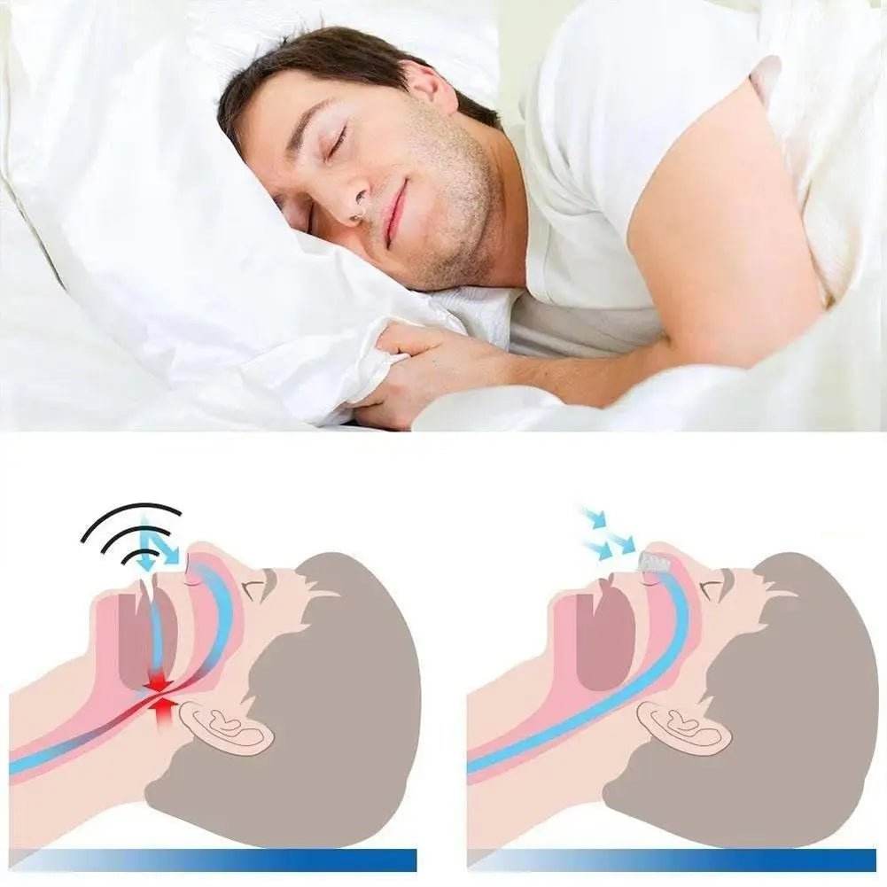 Adjustable Comfortable Anti-Snoring Mouth Guard Appliance - Sleep Galleria