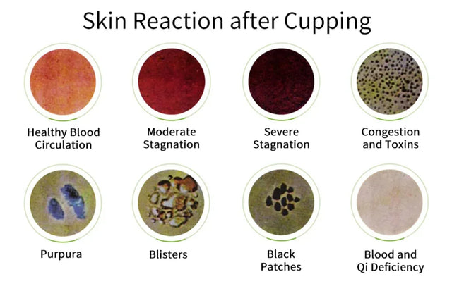 12-Piece Vacuum Cupping Therapy Set With Pump - Omega Lifestyles