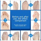 Pair Of Hallux Valgus Toe Bunion Corrector Splint - Omega Lifestyles